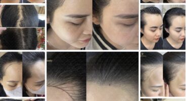 Điêu khắc chân tóc là một kỹ thuật thẩm mỹ tiên tiến, giúp giải quyết những vấn đề như tóc thưa, hói