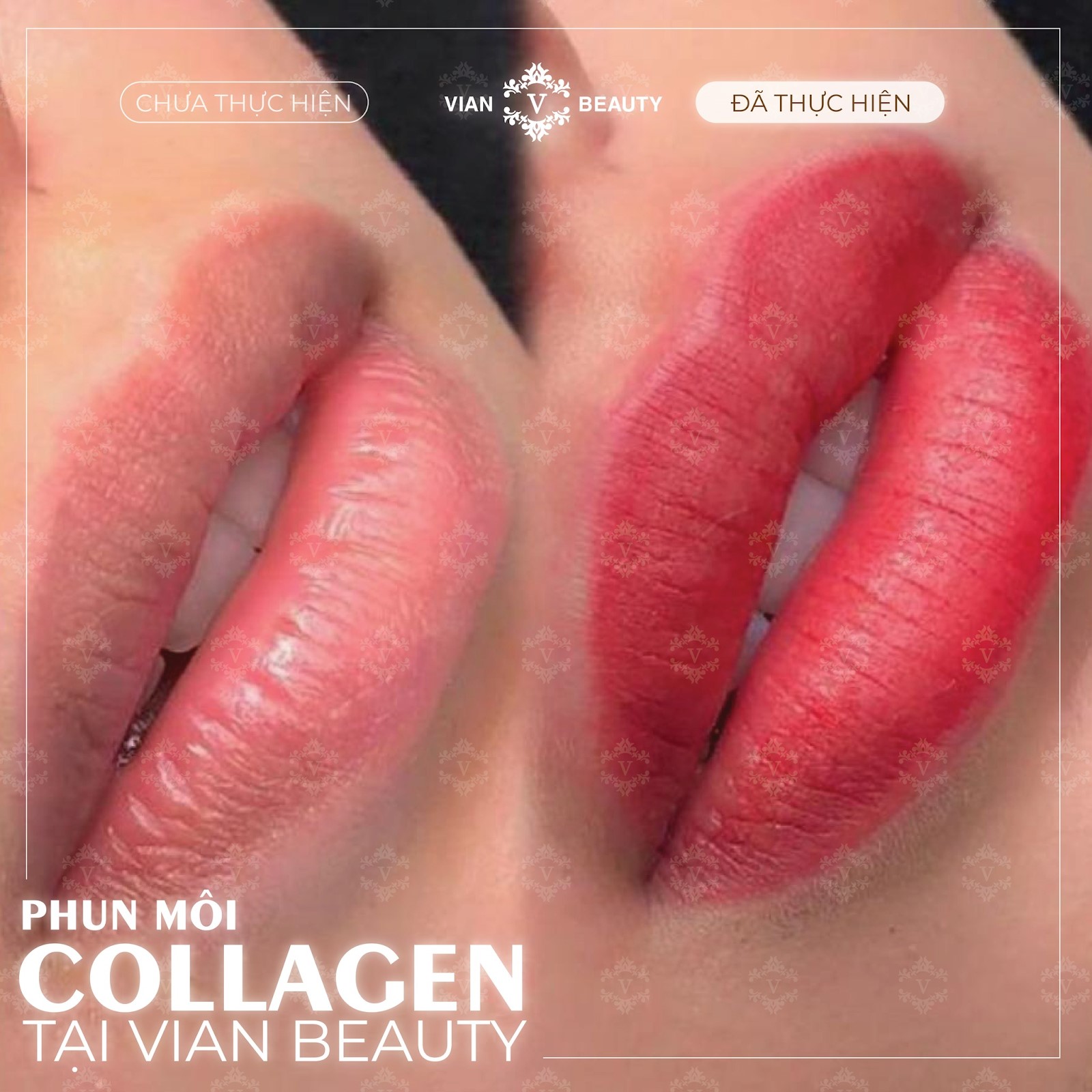 Bảng giá điêu khắc mày môi tại Vian Beauty, chất lượng ra sao? 15 phun moi collagen