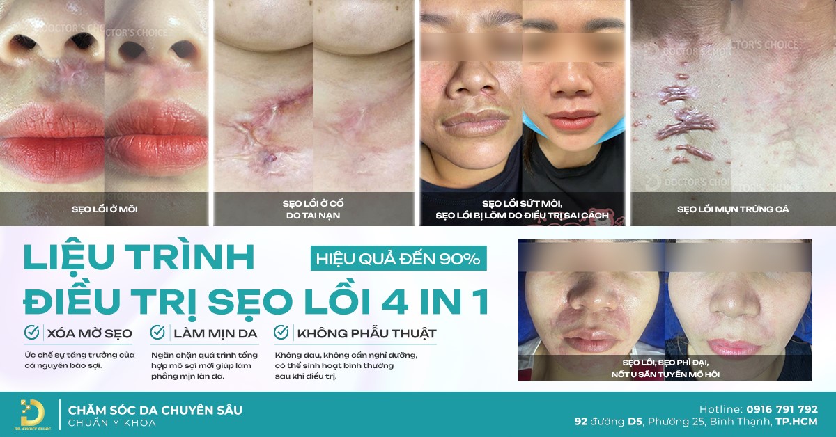Phương pháp điều trị sẹo lồi độc quyền – Công Nghệ 4IN1