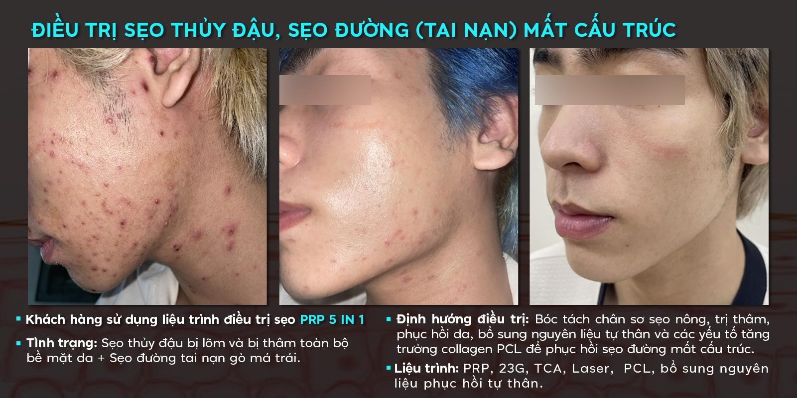 Điều trị sẹo lõm/rỗ – Đột phá với công nghệ kết hợp