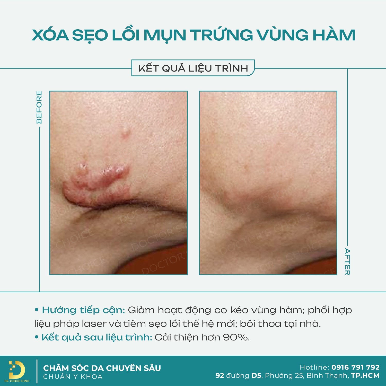 ket qua xoa seo vung ham