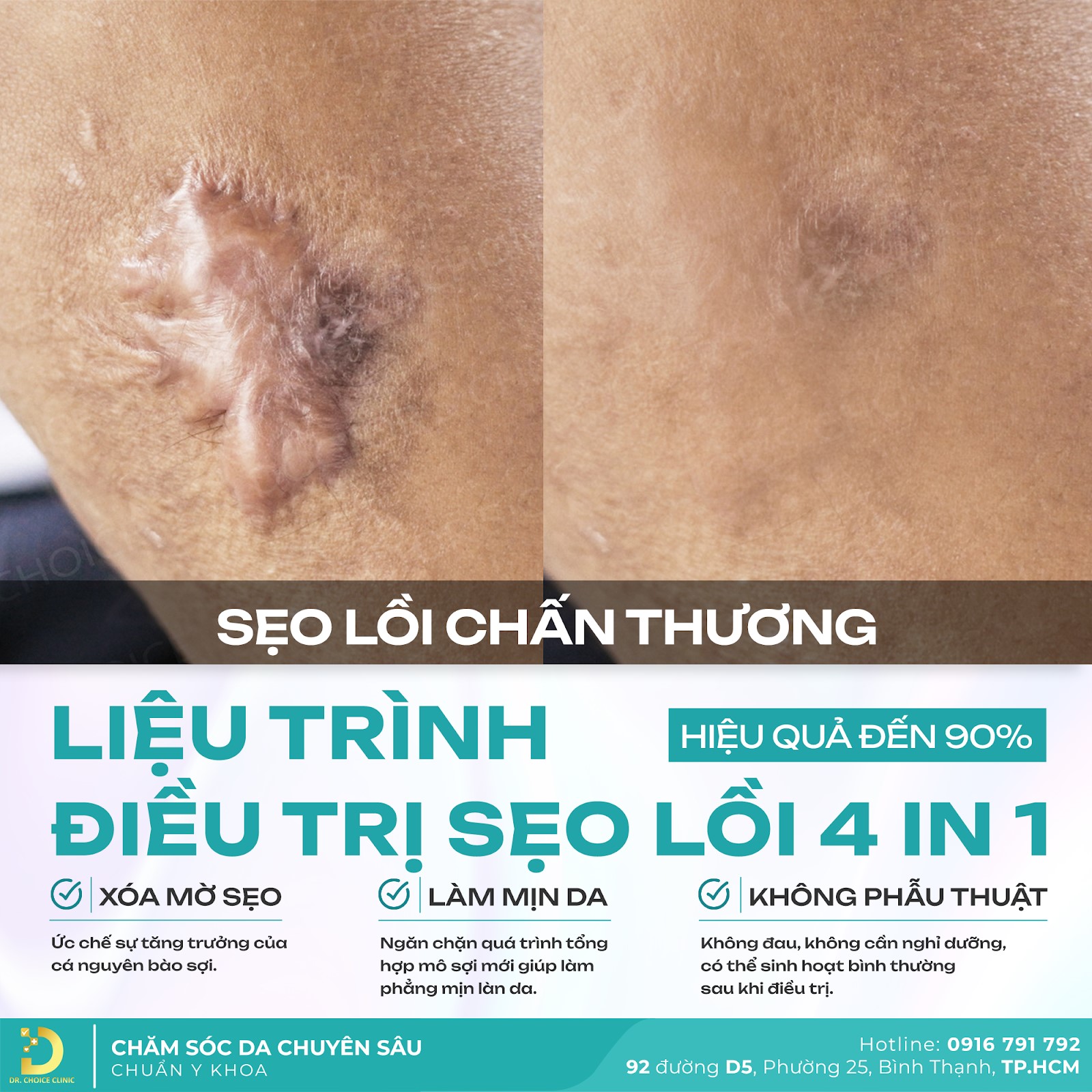 tri seo loi tai dr choice uy tin