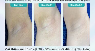 Kết quả điều trị Thâm tại Dr. Choice Clinic