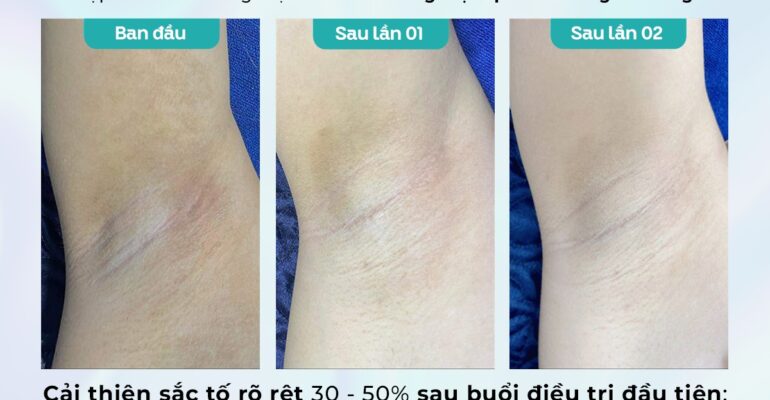 Kết quả điều trị Thâm tại Dr. Choice Clinic