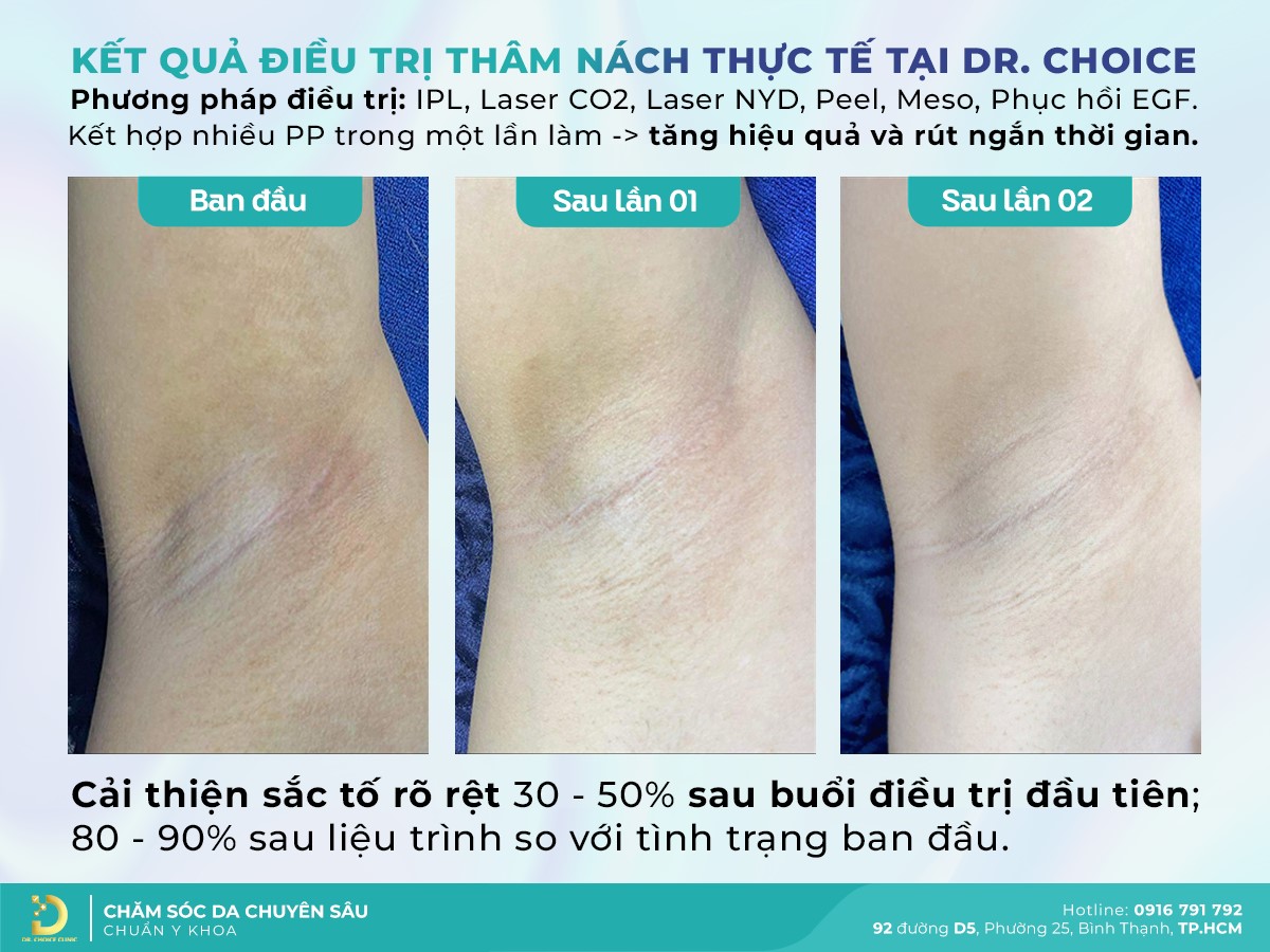 Kết quả điều trị Thâm tại Dr. Choice Clinic